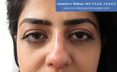 Case 1 - after non surgical rhinoplasty