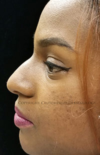 Photos: Woman's face, Before Non-Surgical Rhinoplasty treatment, side view, patient 2